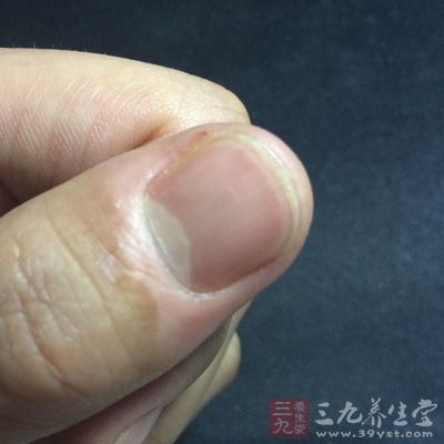 指甲出現白點或絮狀白斑 指甲出現白點或絮狀白斑